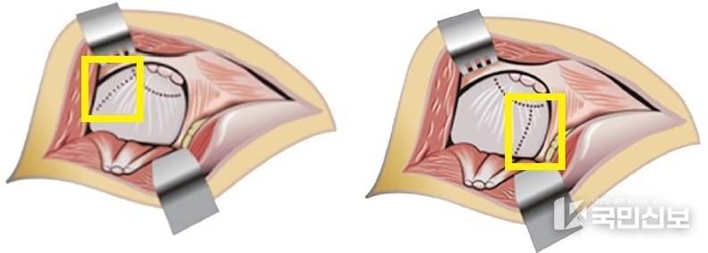 관절낭 위쪽을 절개하는 기존 수술법(좌), 관절낭 아래쪽을 절개하는 파이코 수술법(우)